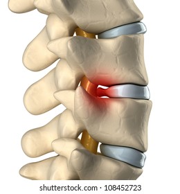 Disc degenerated by osteophyte formation