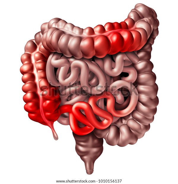 C C Dイラスト 例えば 3dイラストとして閉塞を引き起こす炎症症状を伴う人の腸内の医療コンセプトとしてのc Dコンセプト のイラスト素材