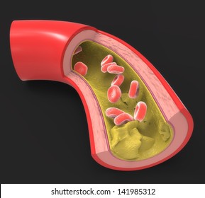 Diseased Artery With Fatty Deposits