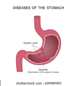 Diseases Stomach Peptic Ulcer Gastritis Vector Stock Vector (royalty 