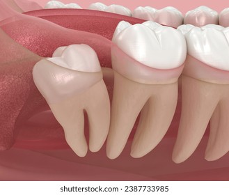 Distal impaction of Wisdom tooth. Medically accurate tooth 3D illustration