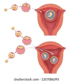 Dizygotic And Monozygotic Human Twins. Embryo