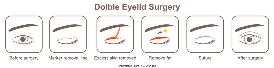 Dolble Eyelid Surgery