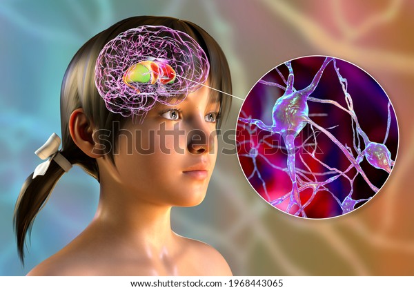 Dorsal striatum\
highlighted in child\'s brain and close-up view of its neurons, 3D\
illustration. It is a nucleus in the basal ganglia, a component of\
the motor and reward\
systems