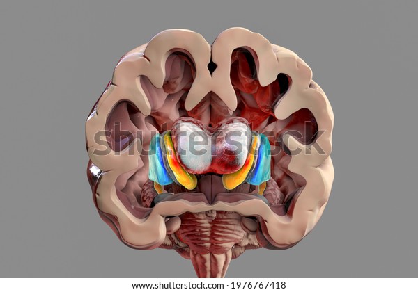 Dorsal striatum and lateral ventricles in\
Huntington\'s disease, 3D illustration showing enlargement of the\
anterior horns of the lateral ventricles and atrophy of the caudate\
nuclei