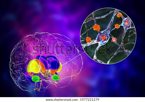 Dorsal Striatum Neurons Huntingtons Disease 3d Stock Illustration 1977221279 6526