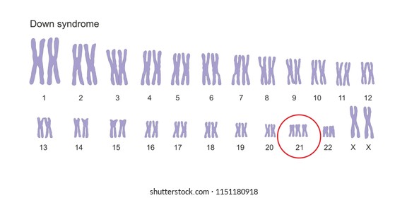 Синдром дауна лишняя хромосома. Синдром Дауна хромосомная карта. Синдром Дауна 21 хромосома. Синдром Дауна схема хромосом. Набор хромосом у человека с синдромом Дауна.