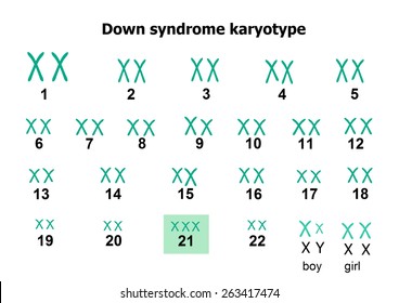 Down Syndrome Karyotype