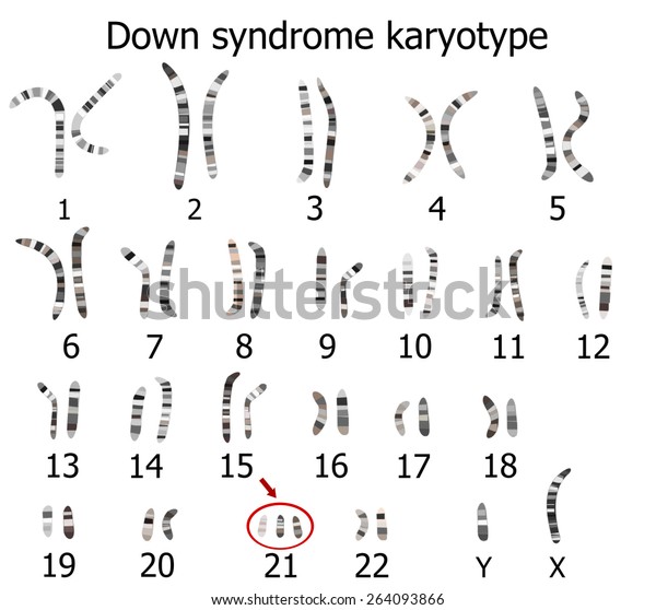 Down Syndrome Karyotype Stock Illustration 264093866 8545