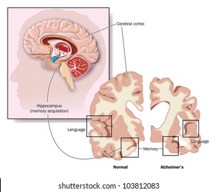 Drawing of the brain, showing the hippocampus and areas of brain involvement in Alzheimer's disease