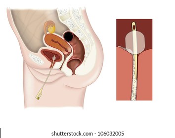 Drawing of a catheter in a female bladder, showing the formation of a biofilm on the catheter wall and urethral wall