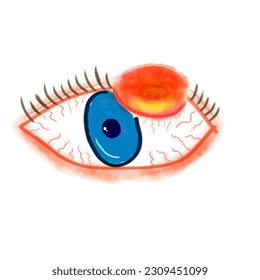 drawing stye hordeolum eyelids