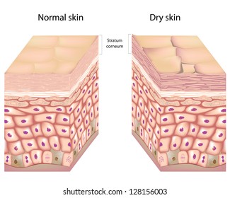 Dry Skin