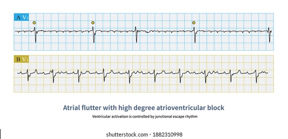 During Atrial Flutter Ventricular Rate Slow Stock Illustration ...