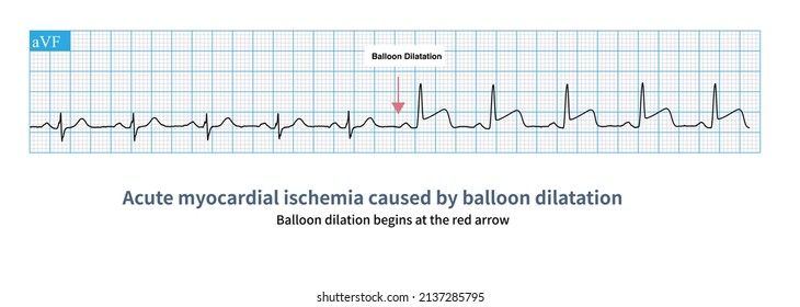 During Coronary Intervention, Balloon Dilatation Can Cause Transient Iatrogenic Myocardial Ischemia, And Monitor ST Segment Elevation Of ECG.