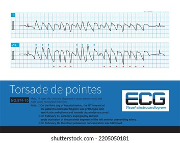 During An Episode Of Torsade De Pointes, The Polarity Of The QRS Complex Is Reversed Around The Isoelectric Line Of The ECG, But Some Leads Are More Consistent In Polarity.