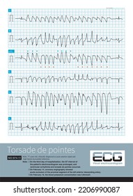 During An Episode Of Torsade De Pointes, The Polarity Of The QRS Complex Is Reversed Around The Isoelectric Line Of The ECG, But Some Leads Are More Consistent In Polarity.