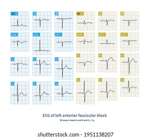 During Left Anterior Fascicular Block Main Stock Illustration ...