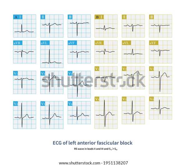 During Left Anterior Fascicular Block Main Stock Illustration ...