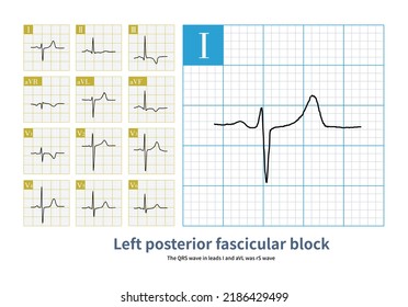 During Left Posterior Fascicular Block Ecg Stock Illustration ...