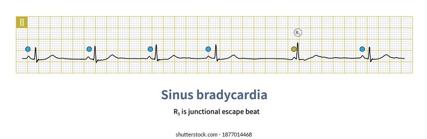 Sinus Arrhythmia High Res Stock Images Shutterstock