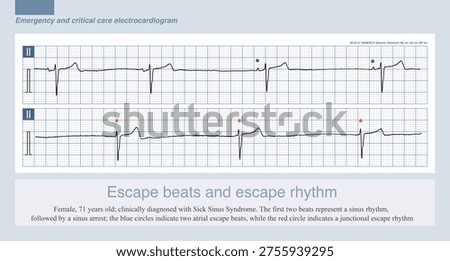 During slow ventricular rhythms, various escape beats and escape rhythms may sometimes occur, including atrial, junctional and ventricular escape beats and their corresponding rhythms.