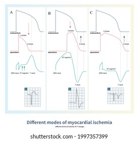 During Transmural Myocardial Ischemia, Different Changes Of Action Potential Curves Of Epicardium And Endocardium Will Produce Different Ischemic ST-T Changes.