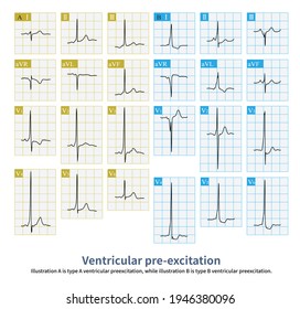 During Ventricular Pre Excitation, QRS Wave And Delta Wave In Lead V1 Were Observed To Judge Whether They Came From Left Or Right Ventricle.