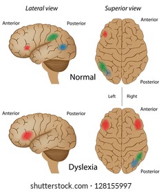 Dyslexia Brain Activity Stock Vector (Royalty Free) 128669393 ...