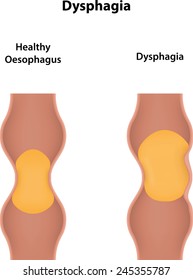 Dysphagia