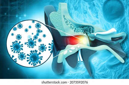 Ear Infection Concept. An Inflammatory Disease Of The Middle Ear. 3d Illustration