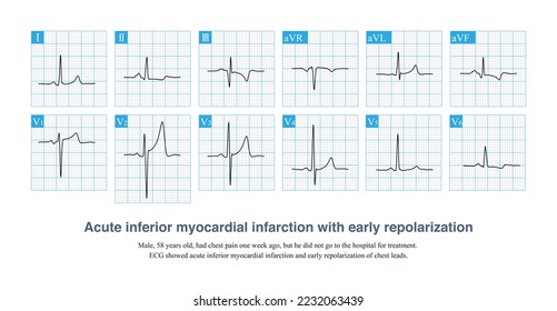 12 Lead Ecg Amplitude Atrial Flutter Stock Illustration 1901661352 ...