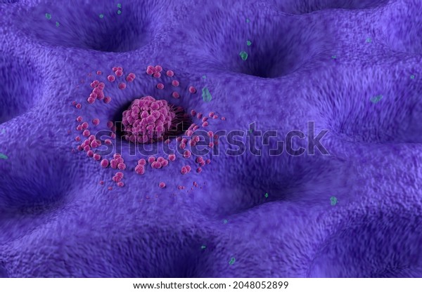 Early stage gastric cancer tumor on the
stomach wall isometric view 3d
illustration