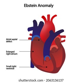 Ebstein Anomaly. Congenital Heart Defect In The Tricuspid Valve.