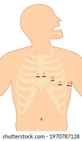 ECG (Electrocardiography) 12-lead Precordial Lead Placement