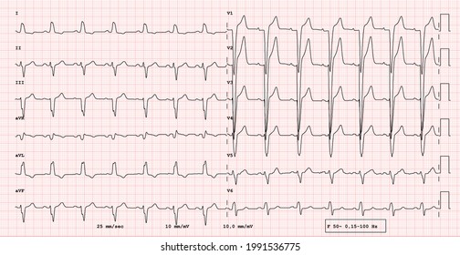 ECG Example Of  12-lead Rhythm,  Left Bundle Branch Block, Real Exam