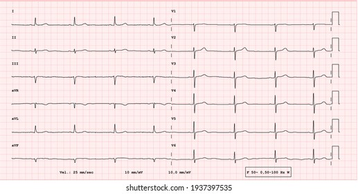 ECG example of a bradycardia 12-lead rhythm