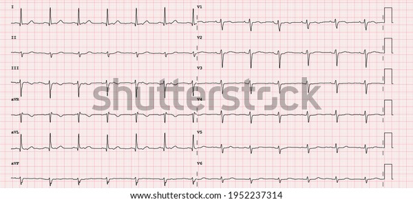 Ecg Example Normal 12lead Sinus Rhythm Stock Illustration 1952237314