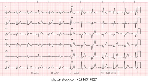 ECG example of a pacemaker 12-lead rhythm