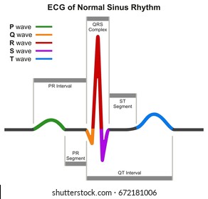 Ecg Chart Labeled