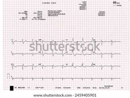 ECG Normal Sinus rhythm with  Right Bundle Branch Block (RBBB)-Vector Illustration-Electrodiagram show abnormal ECG