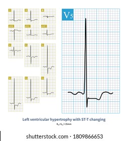 The ECG Of A Patient With Aortic Stenosis Indicates Left Ventricular Hypertrophy With ST Changing.