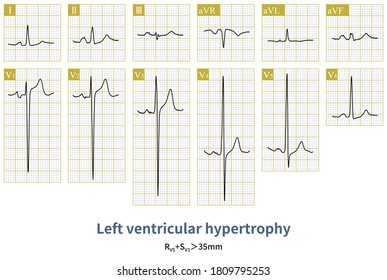 The ECG Of A Patient With Dilated Cardiomyopathy Is Left Ventricular Hypertrophy And Left Atrial Abnormality.