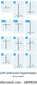 The ECG Of A Patient With Patent Ductus Arteriosus Indicates Left Ventricular Hypertrophy Without ST Changing