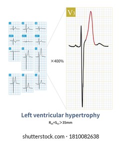 The ECG Of A Patient With Patent Ductus Arteriosus Indicates Left Ventricular Hypertrophy With High T Wave.