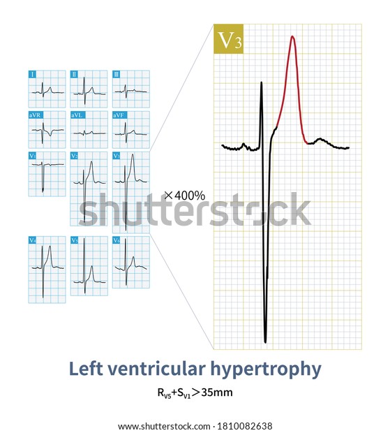 Ecg Patient Patent Ductus Arteriosus Indicates Stock Illustration ...