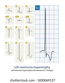 The ECG Of Patients With Left Ventricular Hypertrophy Can Show Extensive ST-segment Depression, Which Is Easily Misdiagnosed As Acute Left Main Disease.