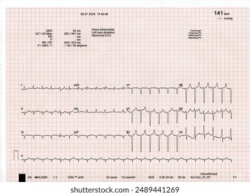ECG Sinus Tachycardia with LAD pattern-Vector Illustration-Electrodiagram show Sinus Tachicardia with Left Axis Deviation
