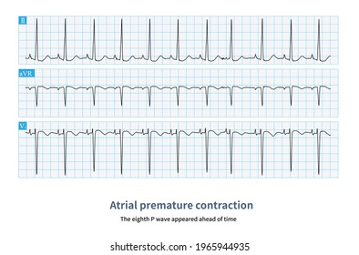 Ectopic P Wave Appeared Advance Compensatory Stock Illustration ...