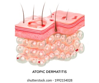 Eczema. 3d illustration of the cross-section of skin layers with atopic dermatitis. Damaged skin.